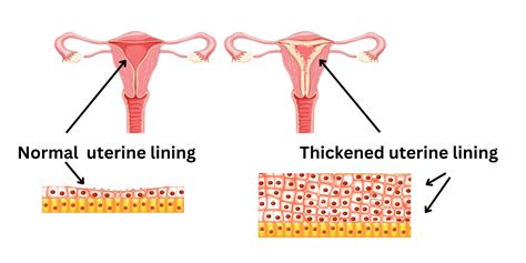 Nurturing Your Inner Sanctuary: A Guide to Thickening Your Uterus Lining