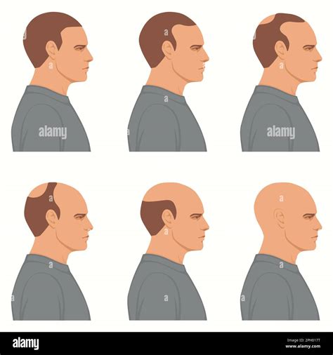 Hope for Hair: Exploring Solutions to Prevent and Reverse Balding