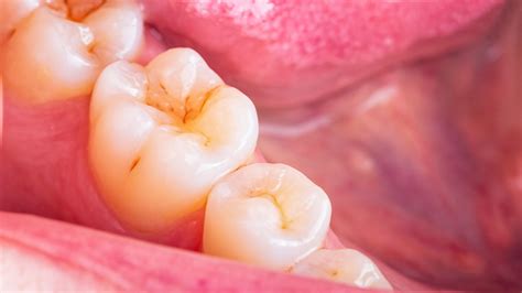 Understanding How Cavities Form: A Guide to Dental Decay