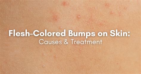 Understanding Flesh-Colored Bumps: Causes, Identification, and Care