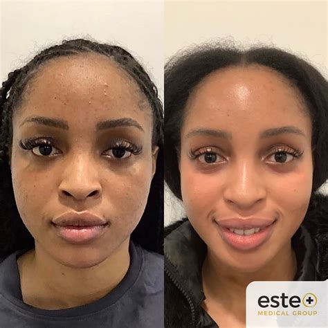 Effective Strategies to Diminish Facial Pigmentation and Reveal Radiant Skin