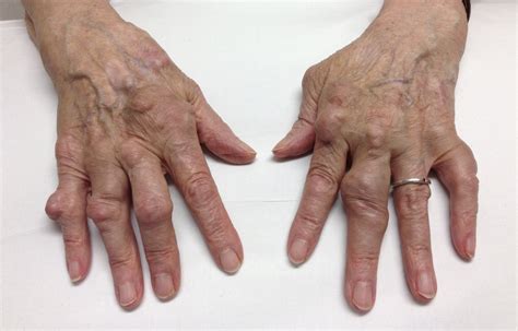 Unraveling the Mystery: Is a Permanent Cure for Rheumatoid Arthritis Possible?