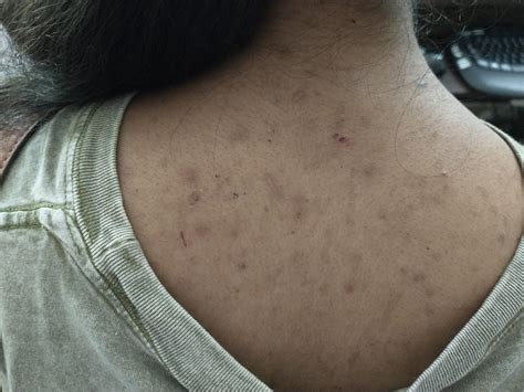 Miracle or Myth: Can You Truly Get Rid of Bacne Scars Overnight?