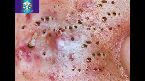 Effective Ways to Clear Forehead Blackheads and Achieve Radiant Skin