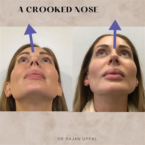 Correcting a Crooked Nose: Understanding Your Options for a Straighter Profile