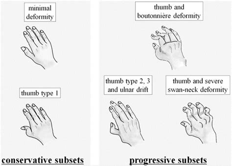 Understanding Rheumatoid Arthritis Progression: What to Expect