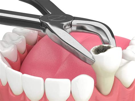 Tooth Extraction Cost Without Insurance: What to Expect and How to Find Affordable Care