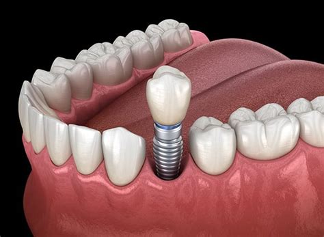 How Much to Replace a Tooth Without Insurance: Your Comprehensive Guide